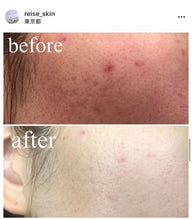 將圖片載入圖庫檢視器 REISE 日本專利碳酸泡沫面膜 (前所未見的透明閃亮皮膚)