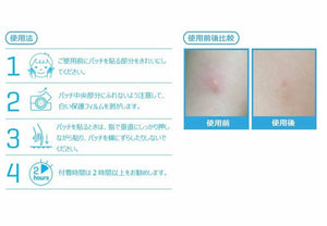 Acropass bugpatch 蚊蟲止癢消炎防抓貼